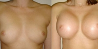 breast2_1
