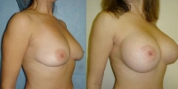 breast4_2